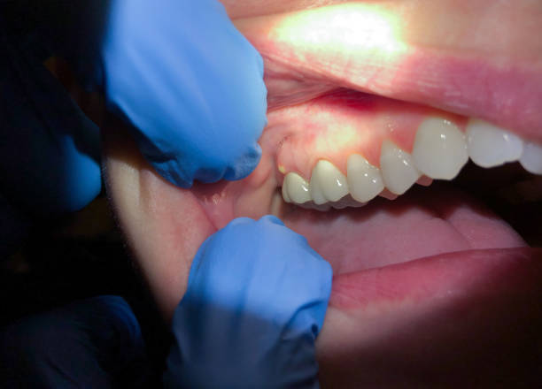 Best Emergency Tooth Extraction in Danville, CA