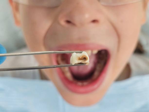 Best Emergency Treatment for Dental Infections or Abscesses in Danville, CA